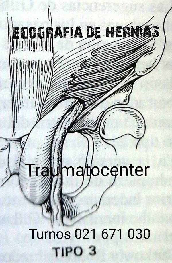 Ecografia de Hernias